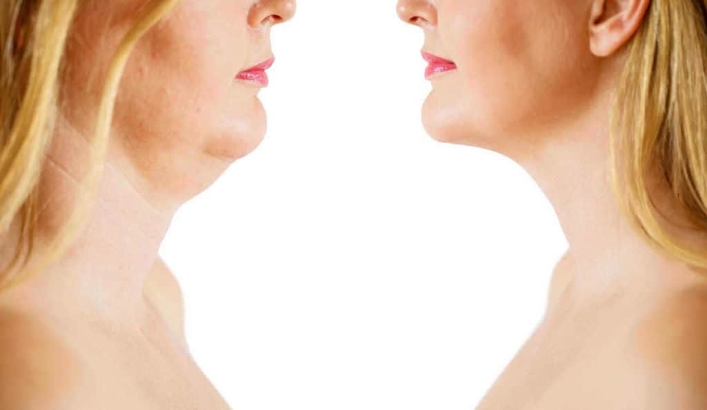 Double Chin treatment Burton upon Trent before and after results