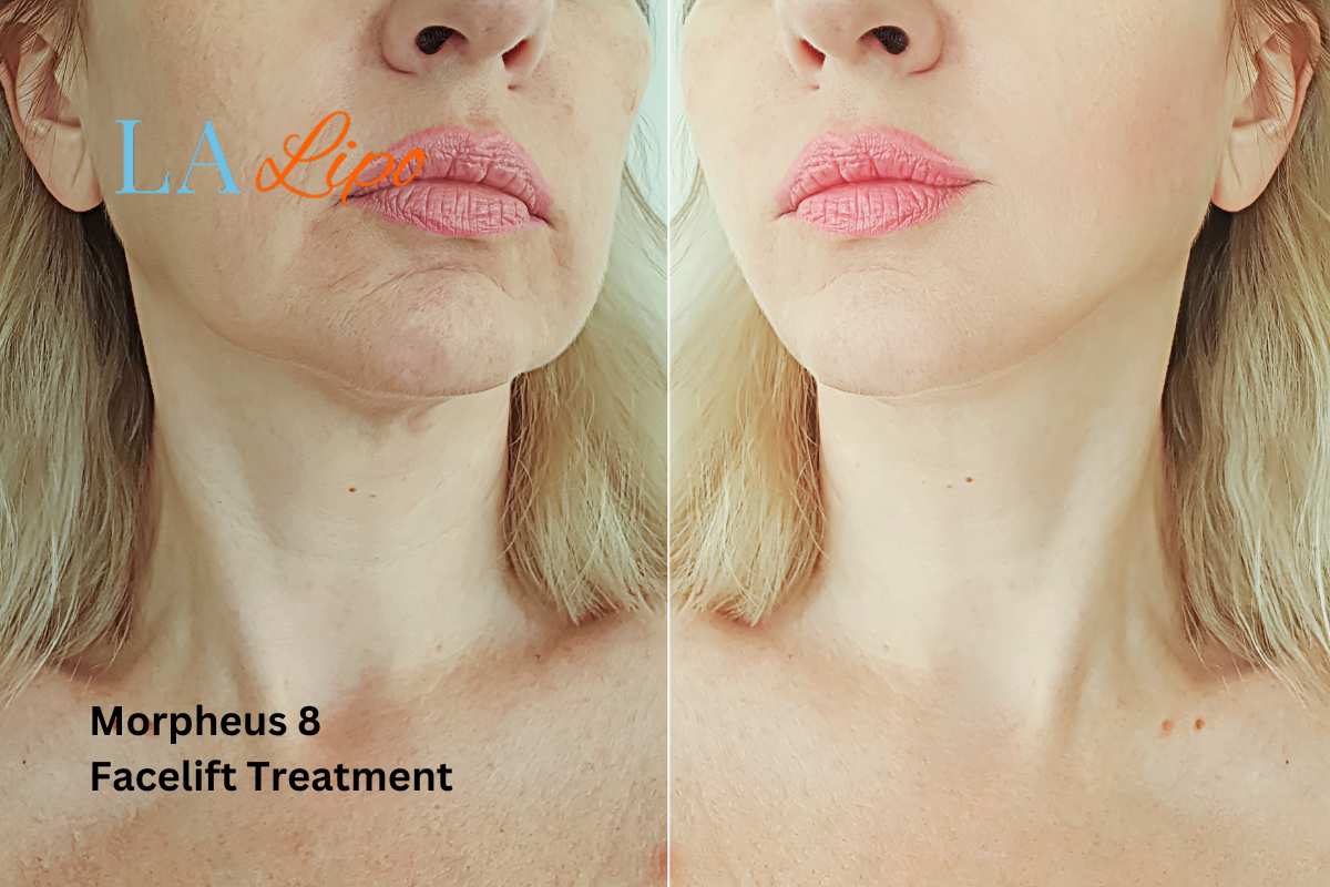 Turn back time with Morpheus8 Treatment Burton upon Trent