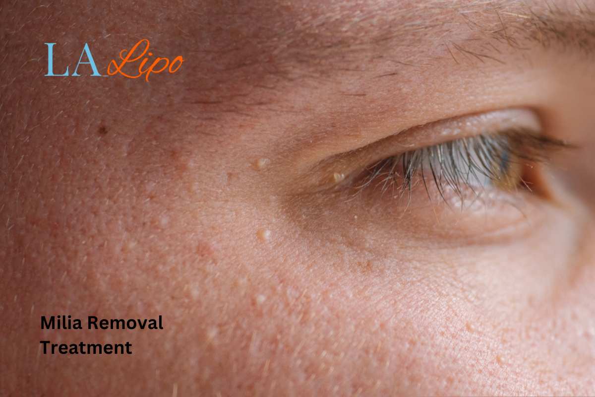 Cryopen Milia Removal: Is It the Easiest and Safest Option Burton upon Trent?