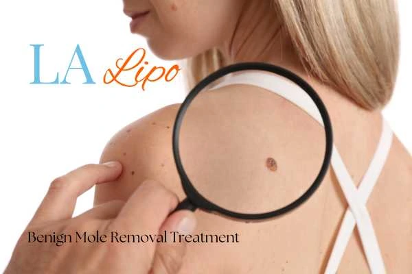 Why getting moles removed Burton upon Trent can boost your confidence!