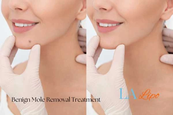 Woman's before and after results of being moles removal treatment Burton upon Trent