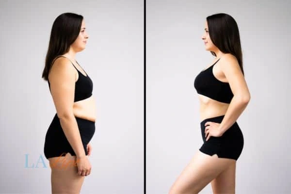 LA-EMS Body Sculpting Burton upon Trent results before and after of womans results on body toning.