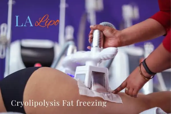 women getting fat freezing Burton upon Trent
