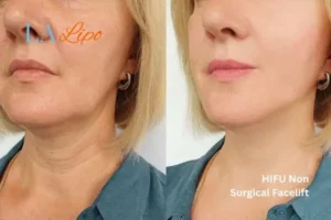 hi-fu for wrinkles Burton upon Trent before and after results