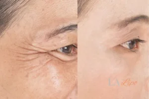 Before and after results of woman - HI-fu wrinkles reduction treatment Burton upon Trent