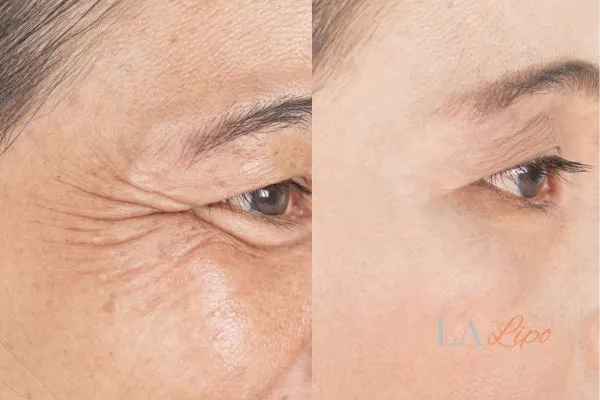 Before and after results of woman - HI-fu wrinkles reduction treatment Burton upon Trent