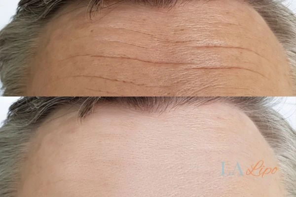 results of HIFU Burton upon Trent on mans forehead to help reduce lines and wrinkles