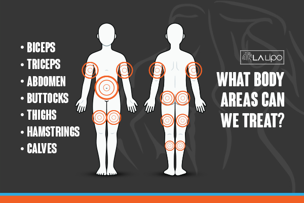 Graphic to show areas you can have LA-EMS Body Sculpting Burton upon Trent treatment.