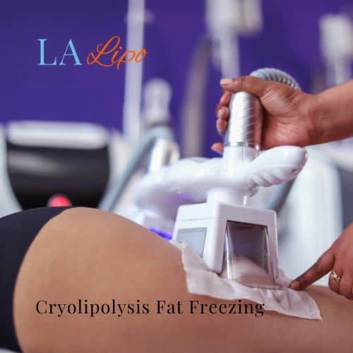 fat freezing - Cryolipolysis Burton upon Trent