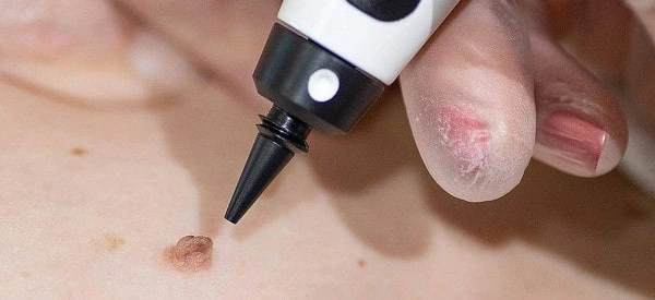 skin tag removal using cryopen Burton upon Trent