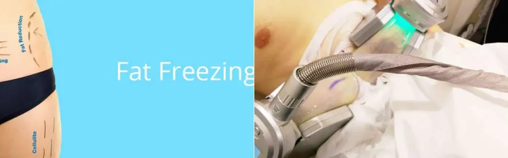 multi areas of a persons body having coolsculpting Burton upon Trent treatment