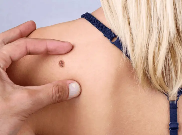 woman having mole removal Burton upon Trent consultation before treatment.