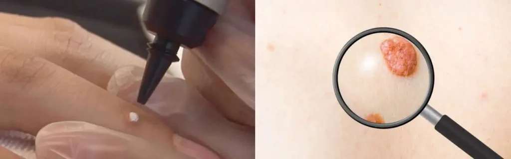 Cryopen for mole removal Burton upon Trent - speak to our team today!