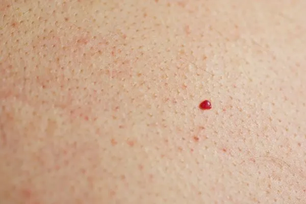 close up of a cherry angioma Burton upon Trent