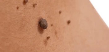 image of a skin tag Burton upon Trent