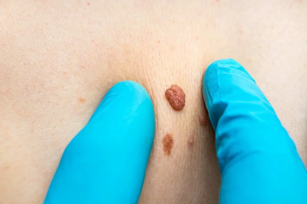 Consultant examining a skin tag Burton upon Trent