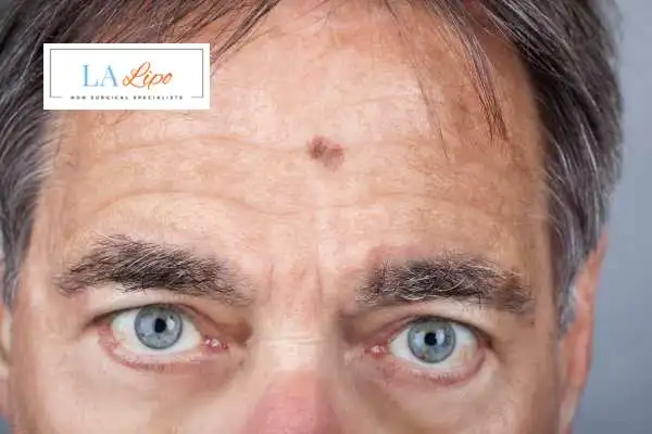 Solar Lentigo Removal Burton upon Trent image of man with mark on his forehead