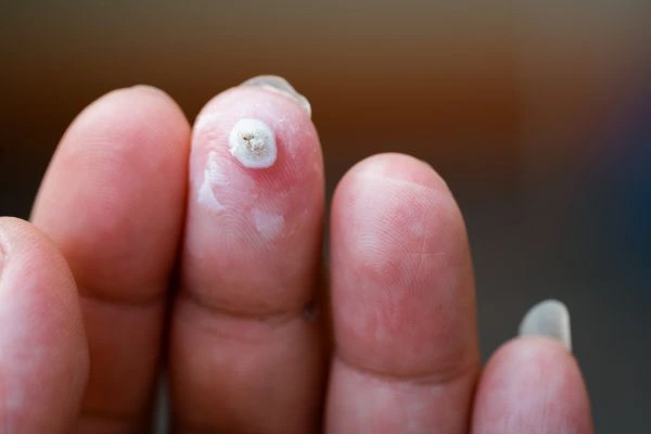 wart on person finger - cryotherapy to treat from LA LIPO Burton upon Trent