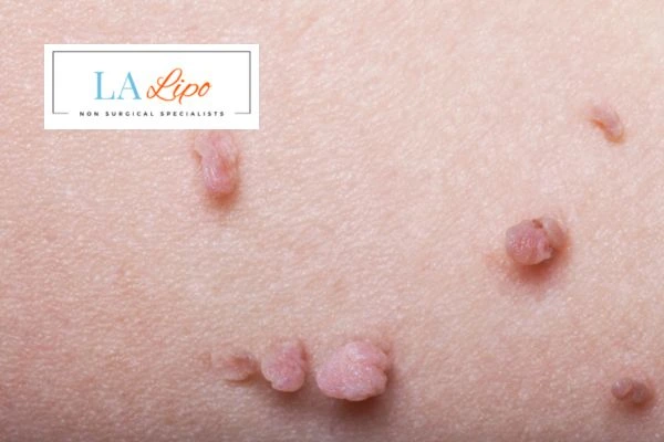 Does cryopen skin tag removal Burton upon Trent hurt? Find out now call our team today!