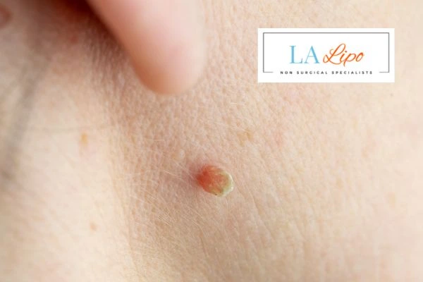 Book skin tag removal Burton upon Trent today speak to our team now!