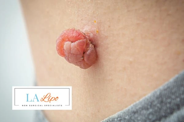 Interested in skin tag removal Burton upon Trent? Concerned about the pain? Find out more today!