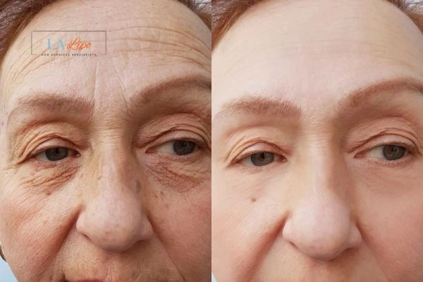 The powerful benefits of Morpheus8 Treatment Burton upon Trent - Call Our team today!