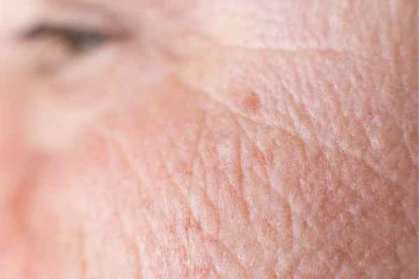 close up picture of a woman's face showing an age spot Burton upon Trent
