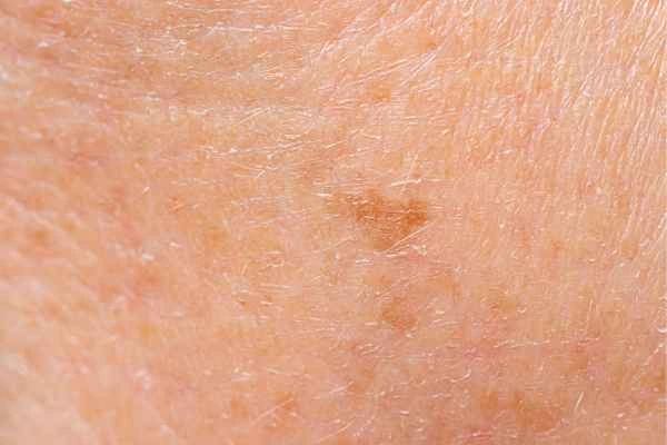close up picture of age spots Burton upon Trent