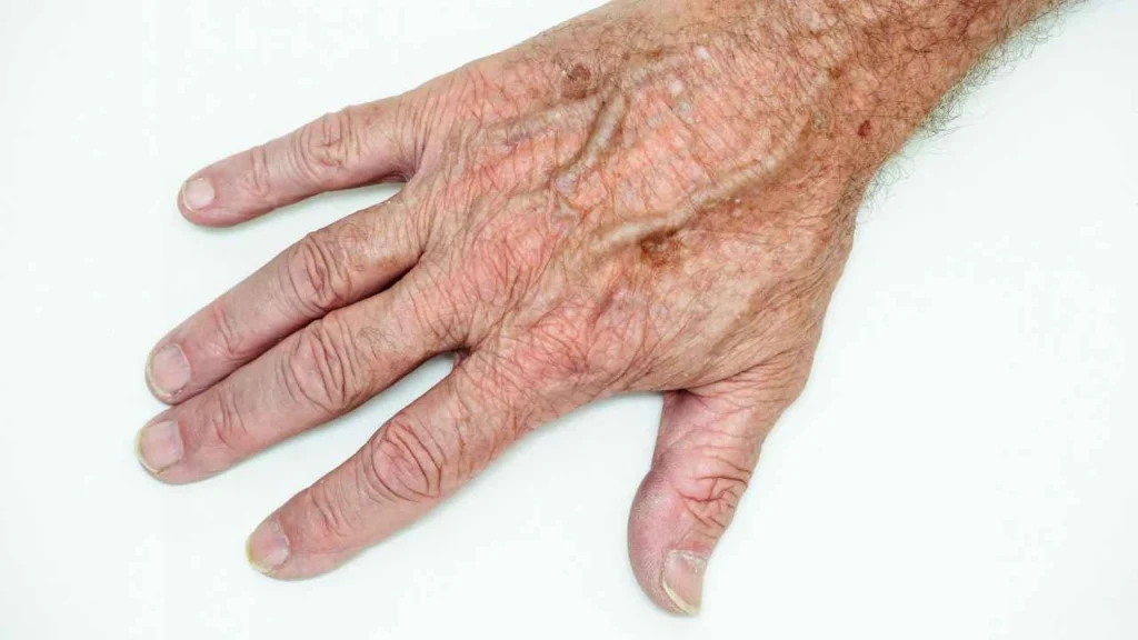 Male hand showing age spot Burton upon Trent