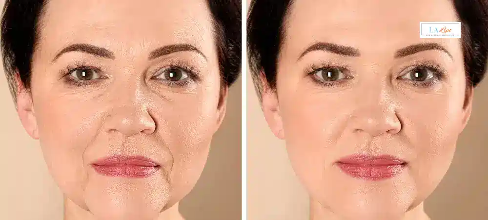 How Long Does It Take to See Results and How Long Do They Last Burton upon Trent?